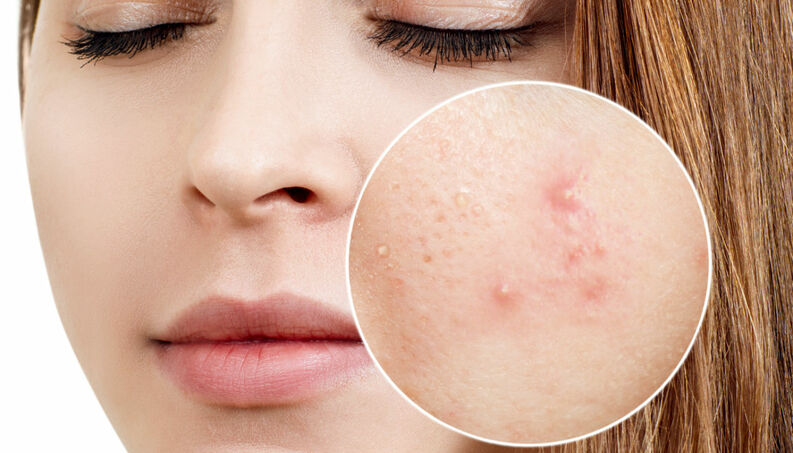 tratamento da acne dermatologista florianopolis