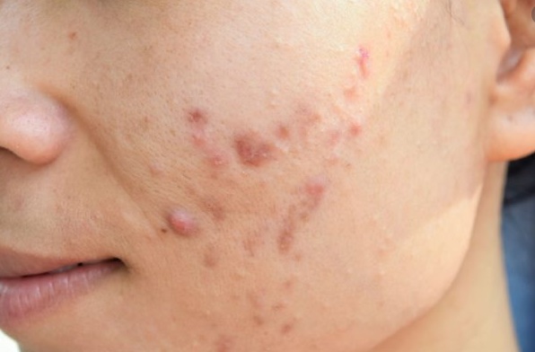 6 remédios caseiros para acnes e manchas na pele