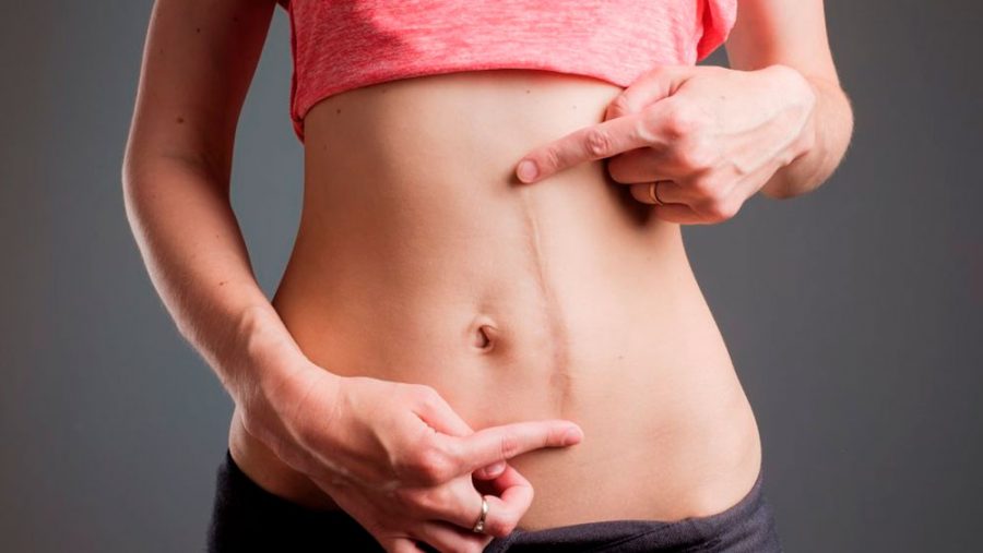 Cirurgia de correção de cicatriz
