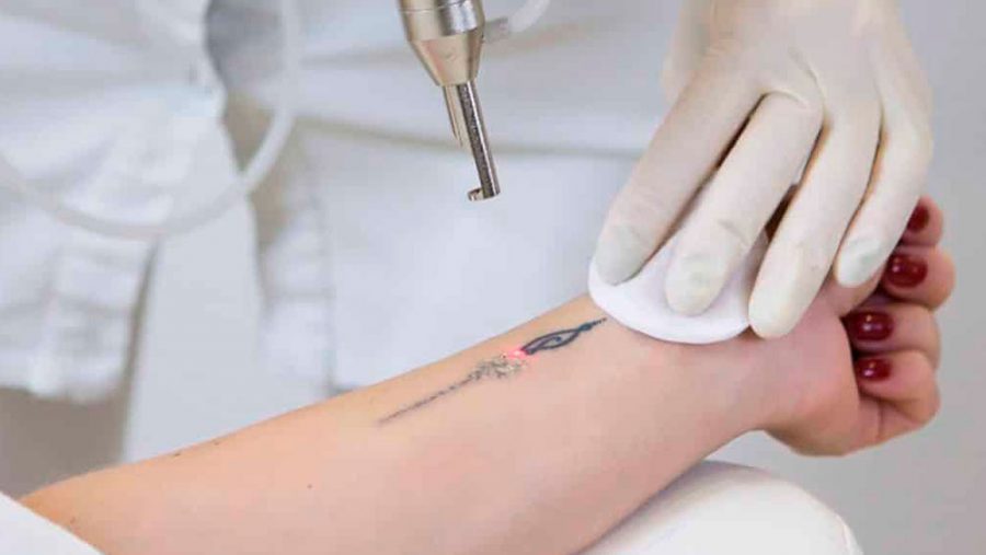 remoção de tatuagem